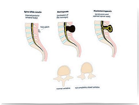 Different forms of spina bifida