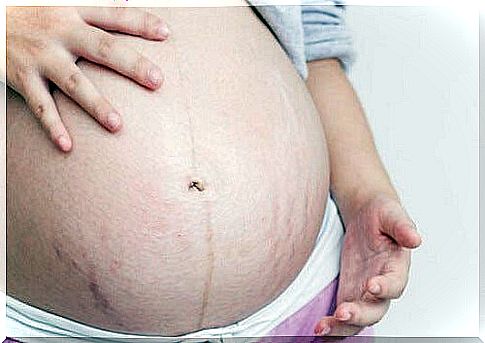 How to prevent stretch marks during pregnancy