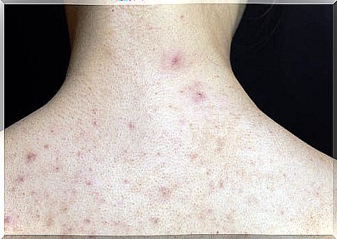 Scarlet fever in children is manifested by a rash