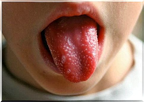 Strawberry tongue is one of the symptoms of scarlet fever in children