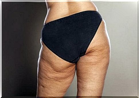 Some tips to combat cellulite